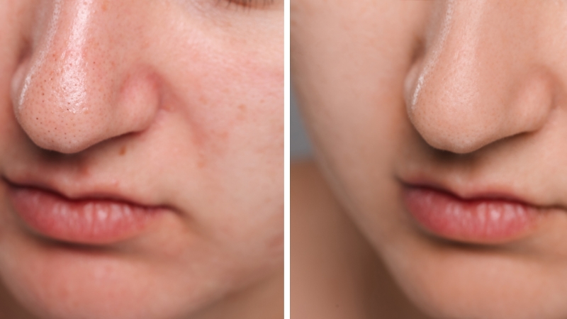 Uporedni prikaz nosa pre i posle nege kože, sa vidljivo smanjenim mitiserima i čišćim porama