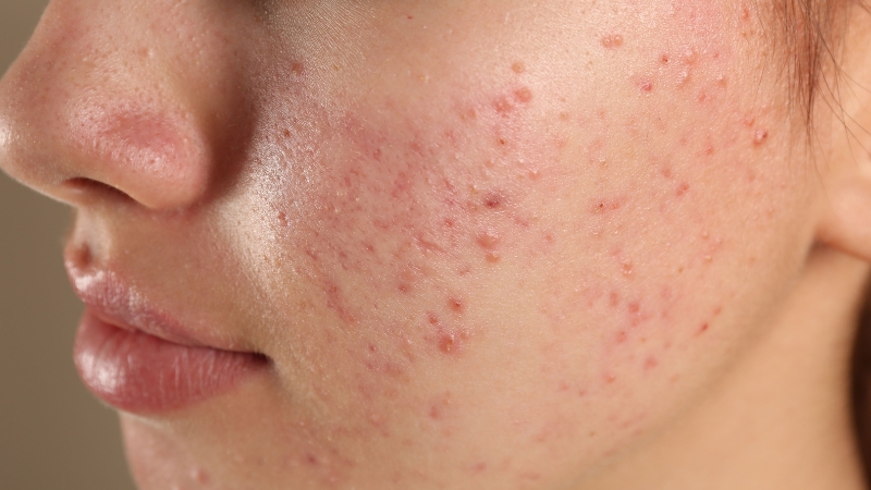 Izbliza prikazan obraz sa izraženim bubuljicama i crvenilom na koži lica
