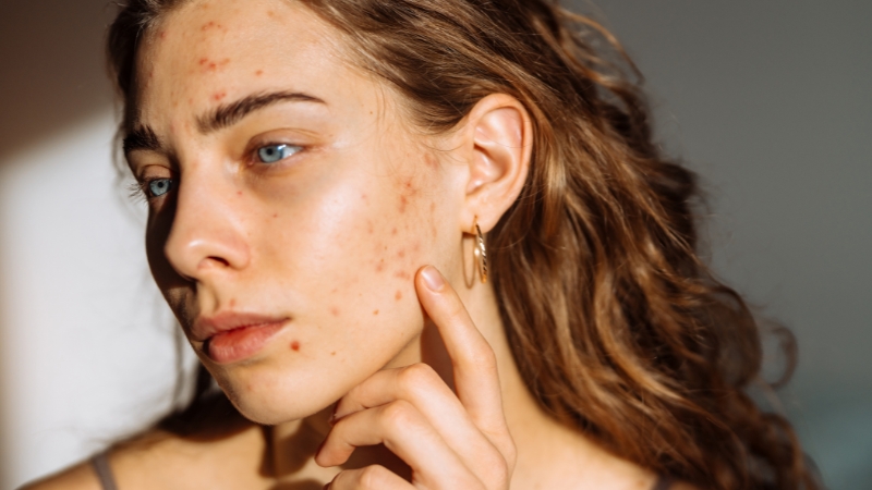 Devojka pokazuje prstom na obraz gde su vidljive bubuljice i sitne nepravilnosti na koži lica