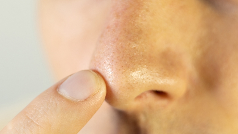 Osoba prstom pokazuje mitisere na nosu i vidljive zapušene pore na koži