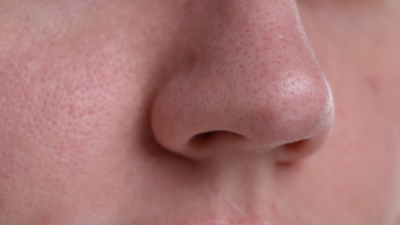 Izbliza prikazan nos sa vidljivim porama i sitnim mitiserima na koži